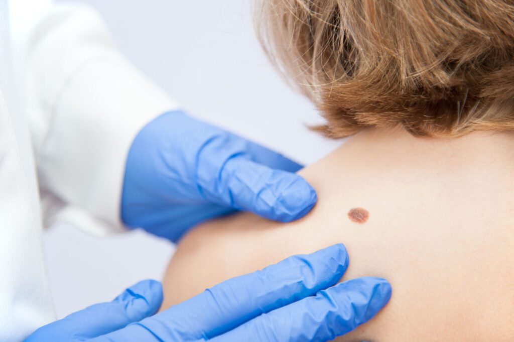 skin cancer early detection