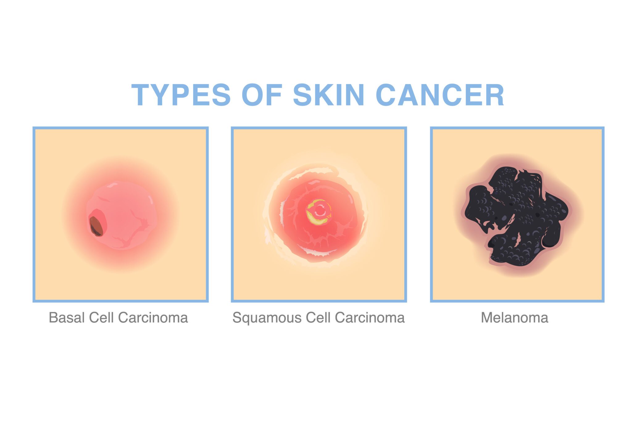 Skin Cancer Early Detection Signs To Watch For Dermatology Associates 4286