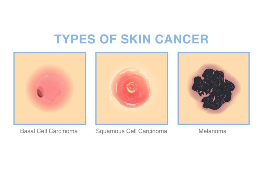Skin Cancer Early Detection Signs to Watch For Dermatology Associates