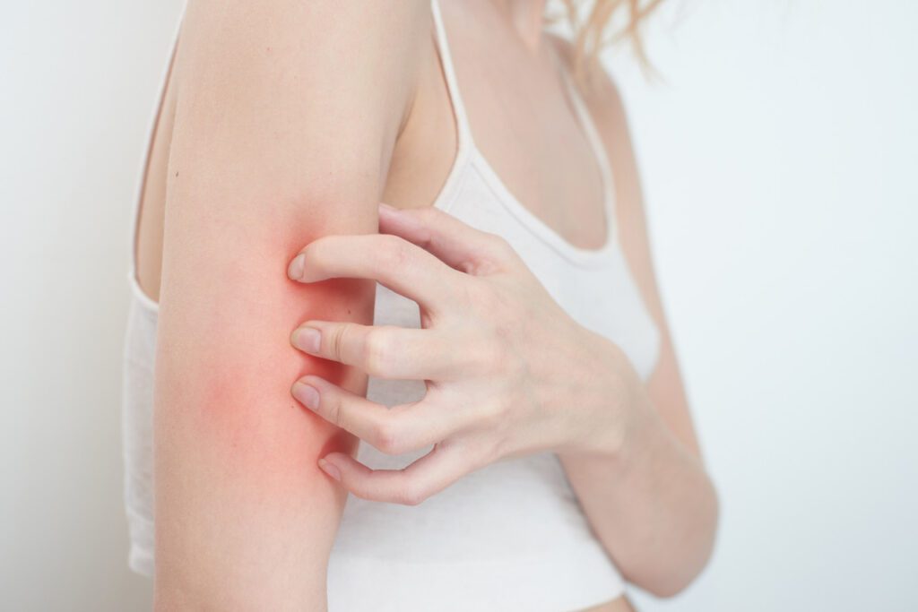 itchy skin - eczema