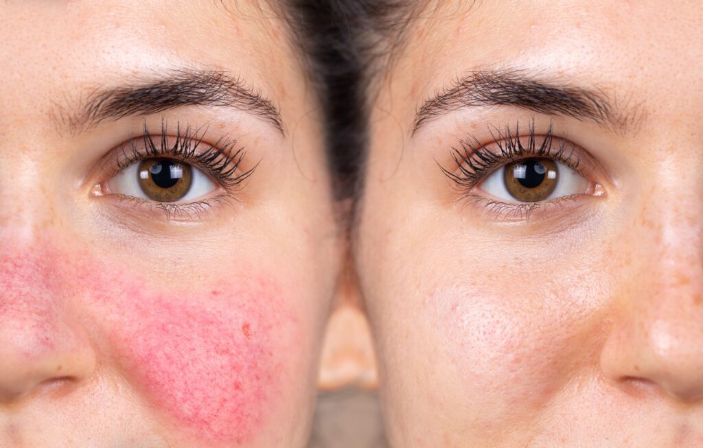 rosacea - woman before and after treatment