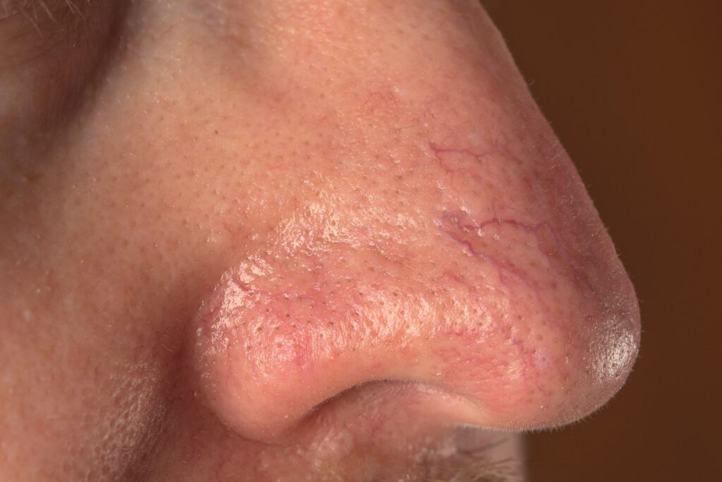 rosacea - on the face and nose